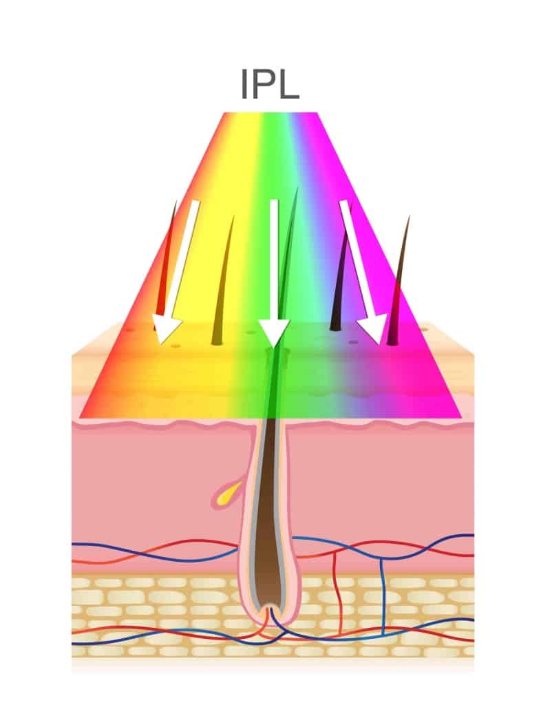 IPL light on chromophore