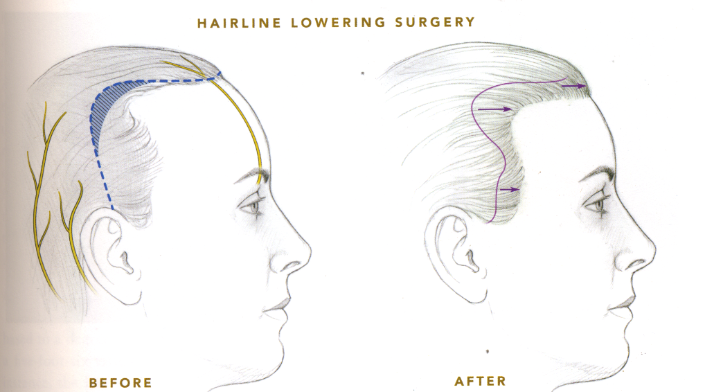 surgical incision for scalp advancement