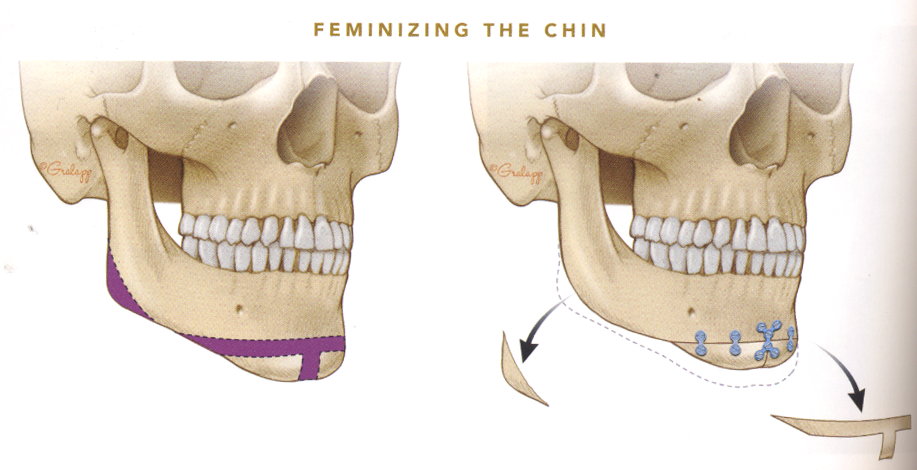 Jaw and Chin Contour