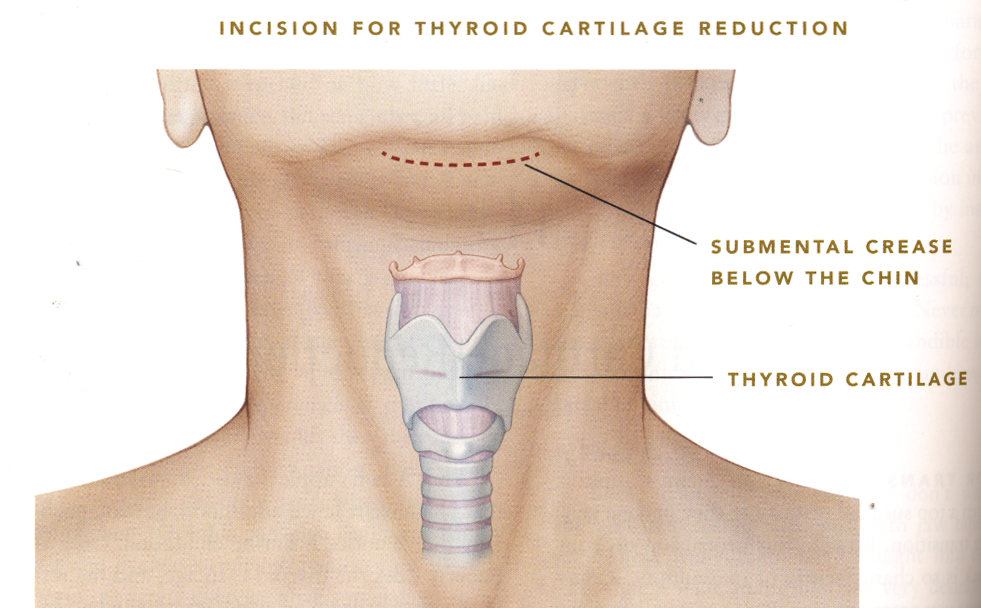 picture of thyroid cartilage reduction