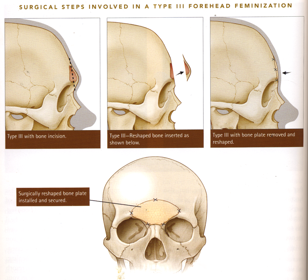 Type 3 forehead contouring