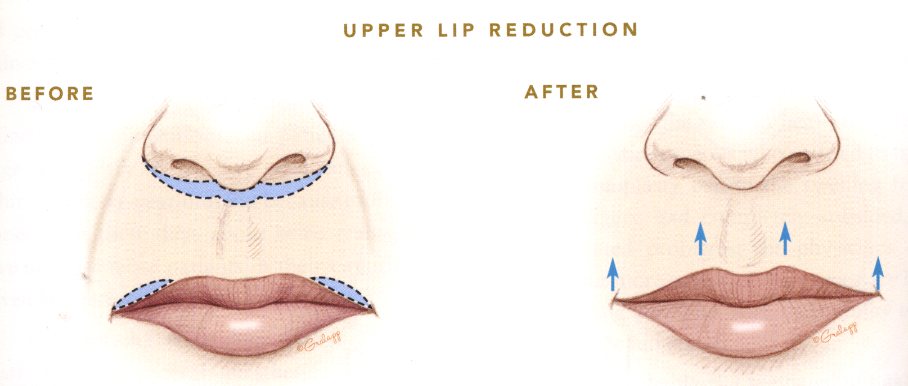 shortening the upper lip