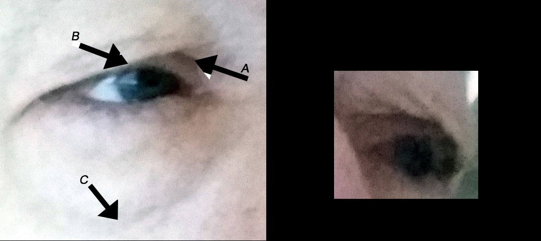 Upper and lower pre-op eyelids.